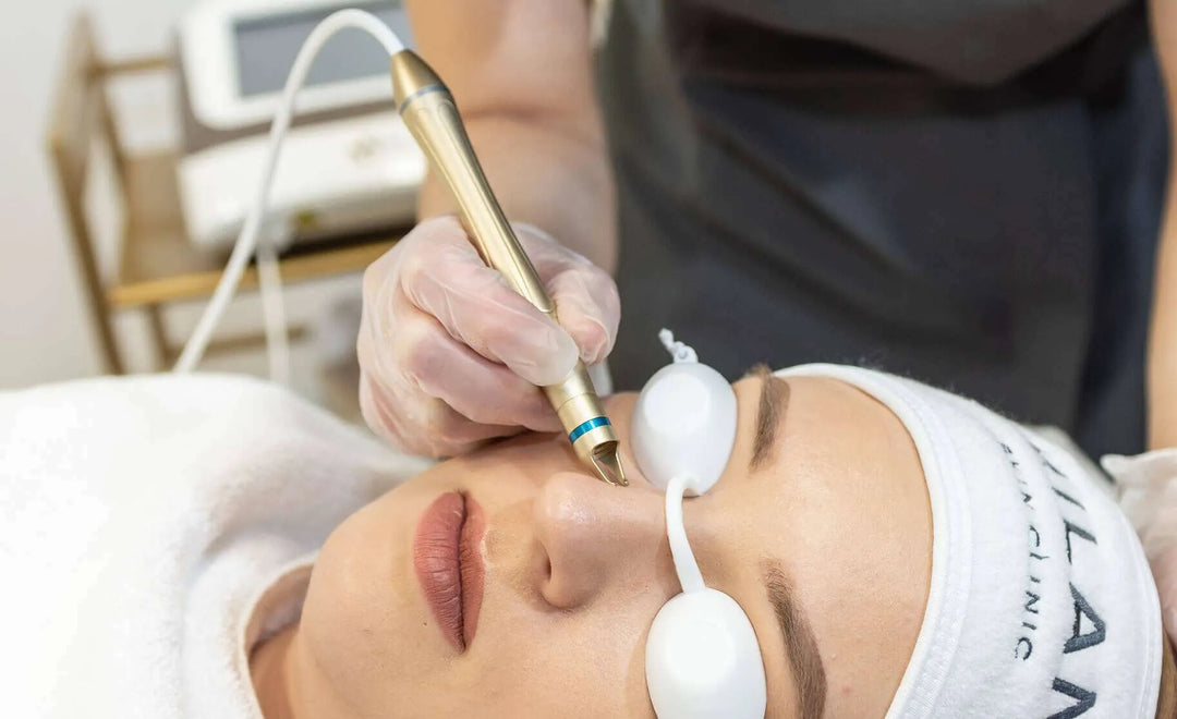 Red Vein Treatment – Only £69 per Area
